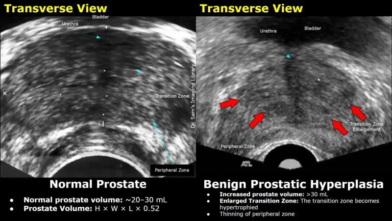 aging male with urinary symptoms graphic