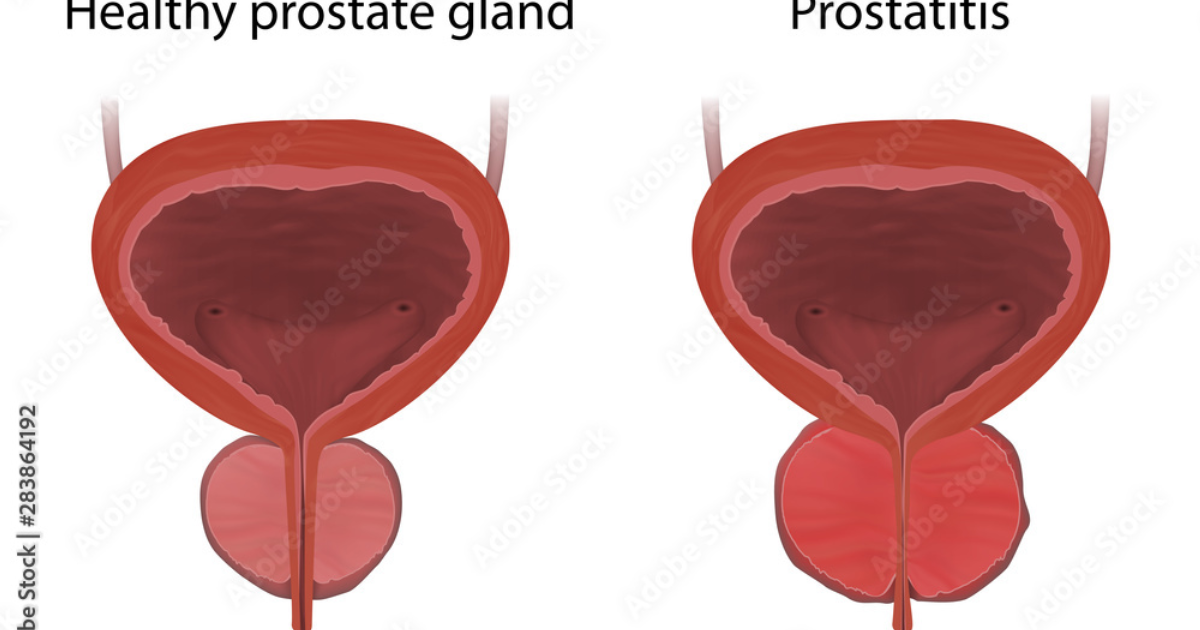 SpartaMax: Prostate Cellular Inflammation — The Silent Saboteur of Male Vitality and How to Quell It