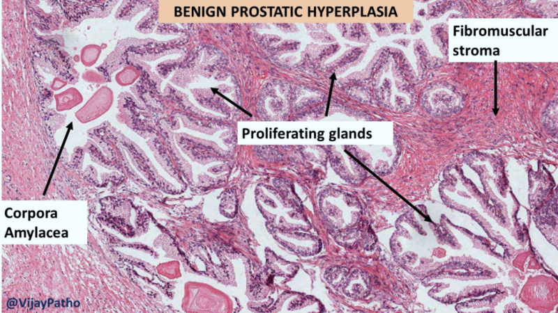 prostate benign hyperplasia cross-section