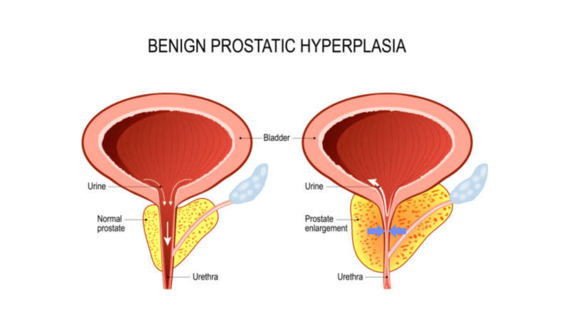 prostate anatomy illustration showing location and compression of urethra