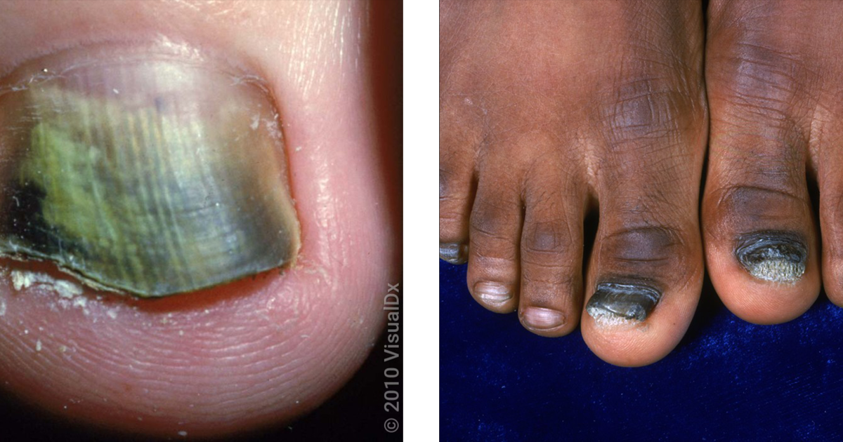 Mycosyn Pro: The Physiological Mechanisms Behind Fungus Elixir and Its Efficacy for Nail Health