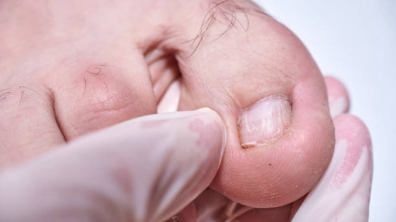 man looking at discolored toenail with expression of concern