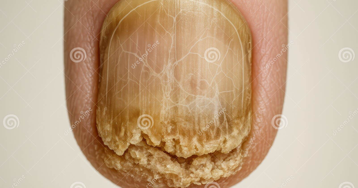 Revanail: The Physiological Mechanisms Behind Fungus Elixir and Nail Health Efficacy