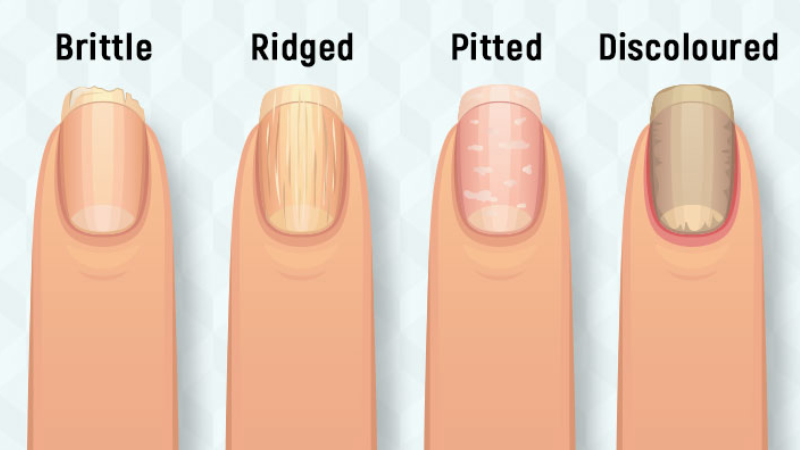 close-up of brittle fingernails with ridges and discoloration