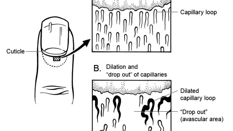 nailfold capillaroscopy image showing capillaries