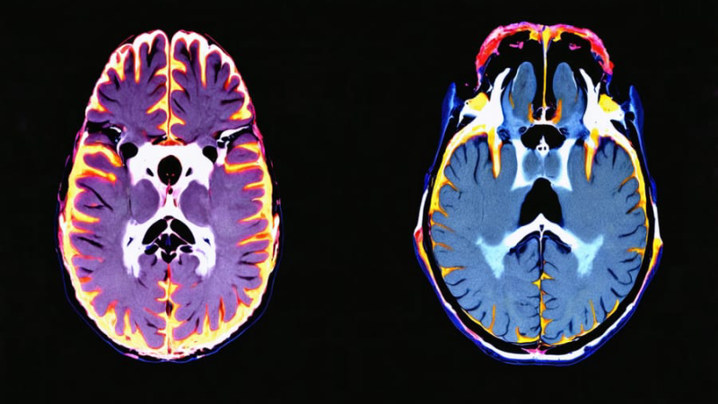 microglial activation brain scan