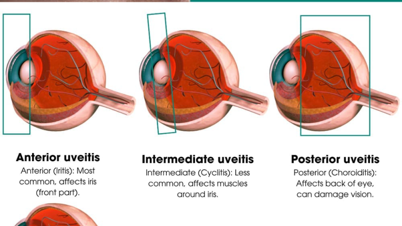 uveitis eye inflammation anatomy