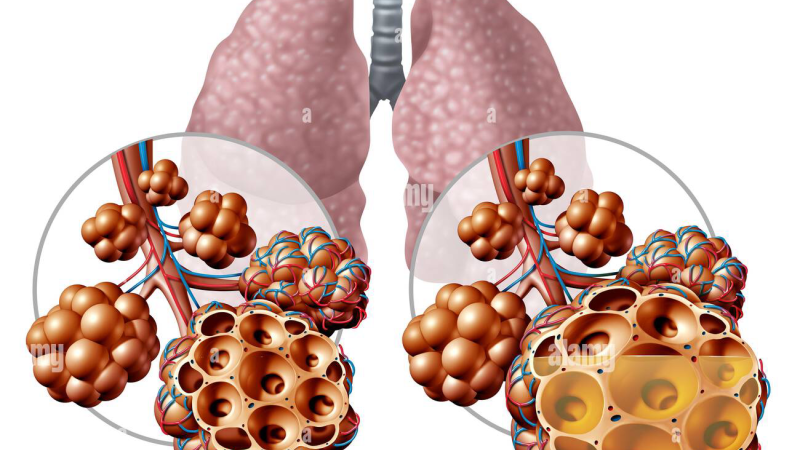 lung alveoli inflammation illustration