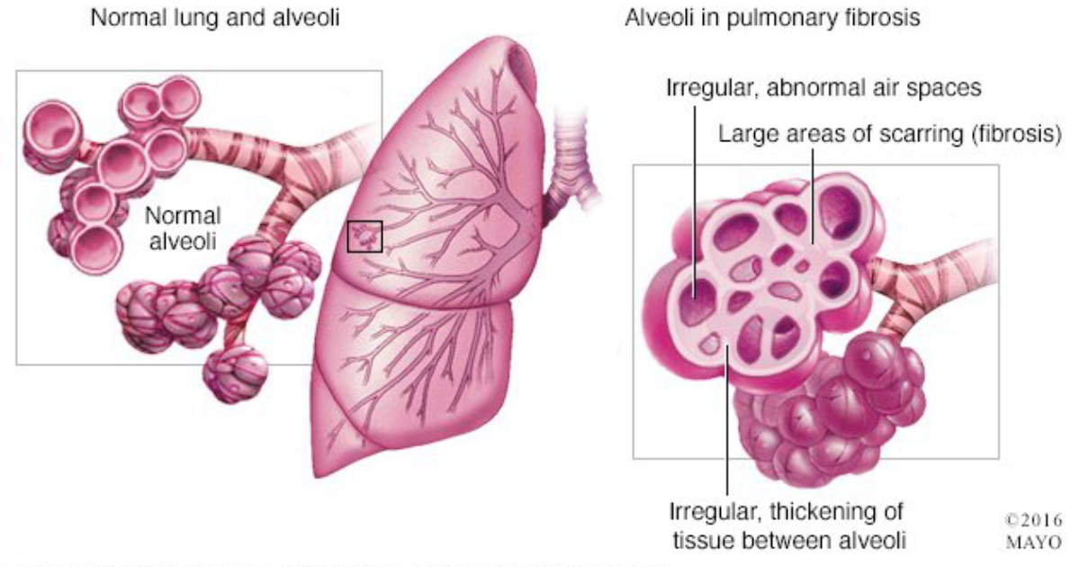 Pulmo Balance: The Mechanism of Pulmonary Fibrosis – From Scarring to Breathlessness