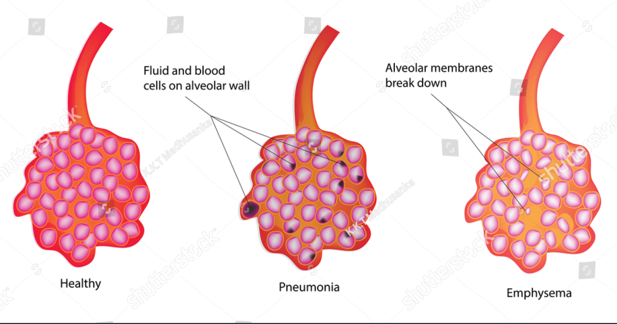 Pulmo Balance: What Happens to Lung Tissue After 30 Days of Smoking Cessation? A Cellular View