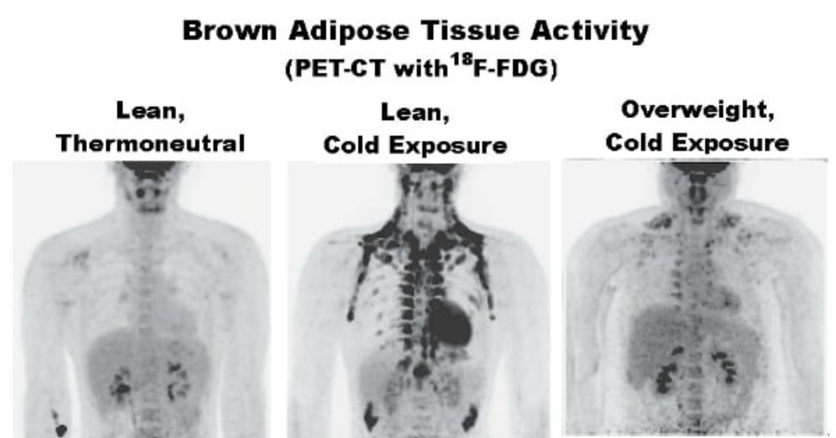 21KETO Gummies: Cold Water Immersion vs. Cryotherapy – Activating Brown Fat for Weight Loss