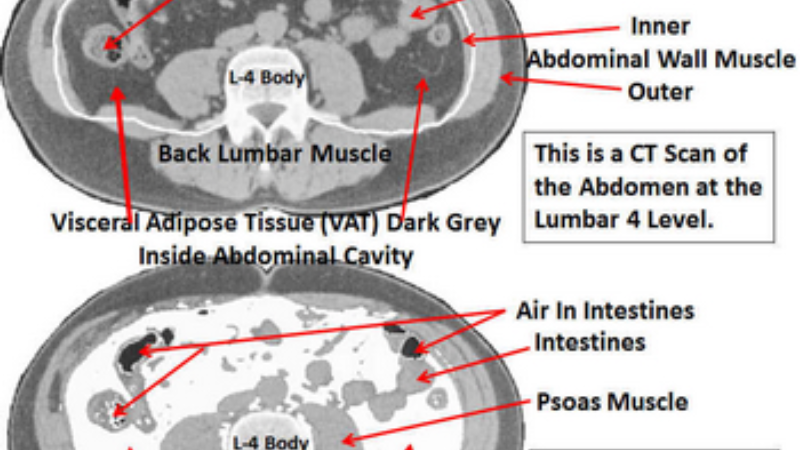 visceral fat accumulation around organs MRI scan