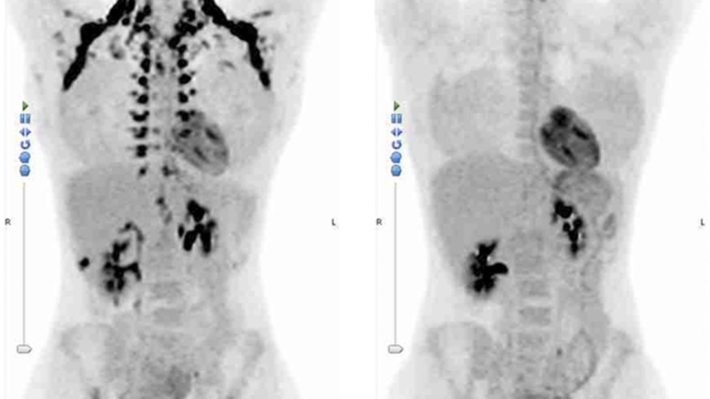 PET-CT scan of brown adipose tissue activation in supraclavicular area