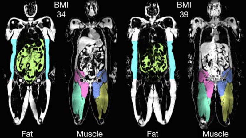 visceral fat accumulation around abdominal organs illustration