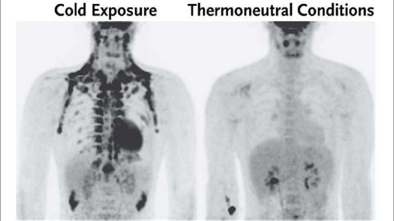 cold exposure brown fat