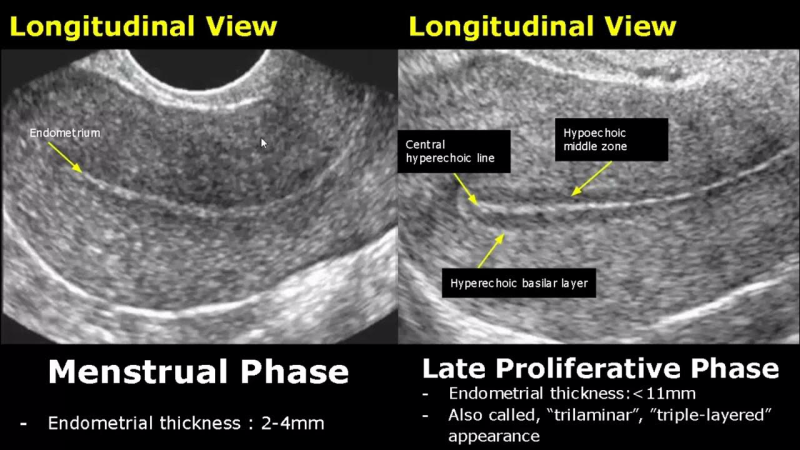 endometrial lining ultrasound healthy women